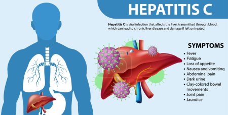 Illustration for Informative Symptoms of Hepatitis C illustration - Royalty Free Image