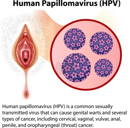 Ilustración de Human Papillomavirus with explanation illustration - Imagen libre de derechos
