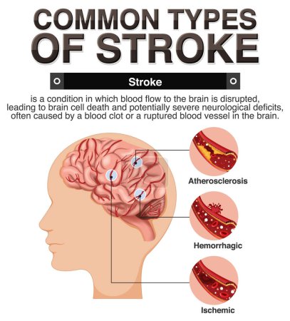 Illustration for Informative poster of common types of stoke illustration - Royalty Free Image
