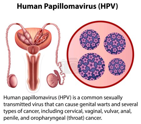 Ilustración de Human Papillomavirus with explanation illustration - Imagen libre de derechos
