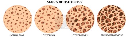 Illustration for Stages of Osteoposis Vector illustration - Royalty Free Image