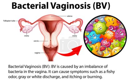 Ilustración de Bacterial Vaginosis (BV) infographic with explanation illustration - Imagen libre de derechos