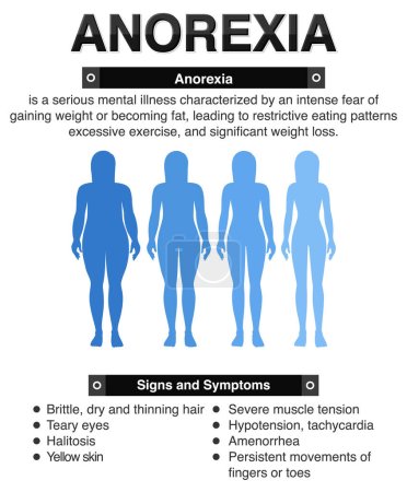 Ilustración de Anorexia (anorexia) y sus efectos en el cuerpo ilustración - Imagen libre de derechos