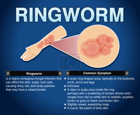 Informative poster of ringworm illustration