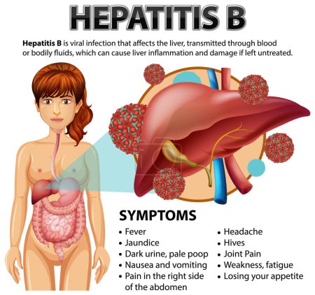 Ilustración de Síntomas de la hepatitis B ilustración - Imagen libre de derechos