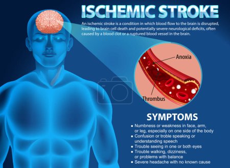 Illustration for Informative poster of Ischemic stroke illustration - Royalty Free Image