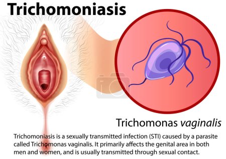 Illustration for Trichomoniasis infographic with explanation illustration - Royalty Free Image