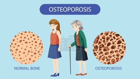Densidad ósea y osteoporosis Vector ilustración