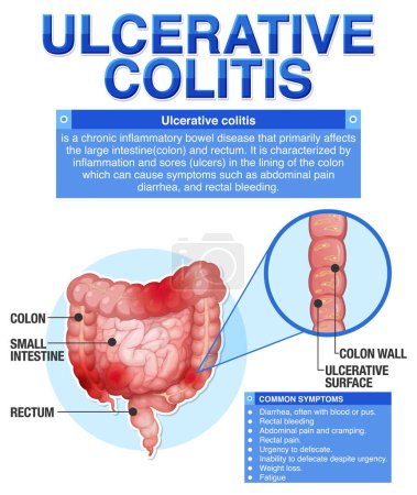 Ilustración de Colitis ulcerosa Síntomas Infografía ilustración - Imagen libre de derechos