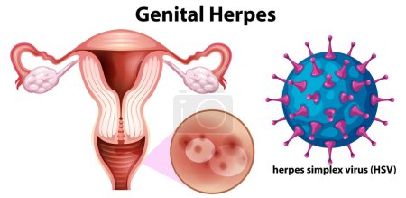 Genital Herpes with herpes simplex virus (HSV) illustration