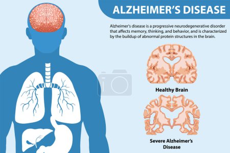 Téléchargez les illustrations : Affiche informative de l'illustration de la maladie d'Alzheimer - en licence libre de droit