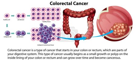 Téléchargez les illustrations : Cancer colorectal avec illustration explicative - en licence libre de droit