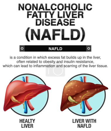 Illustration for Nonalcoholic fatty liver disease illustration - Royalty Free Image