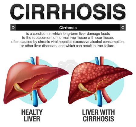 Ilustración de Cirrosis del hígado Ilustración infográfica - Imagen libre de derechos