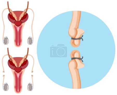 Ilustración de Ilustración del concepto de esterilización masculina o femenina - Imagen libre de derechos