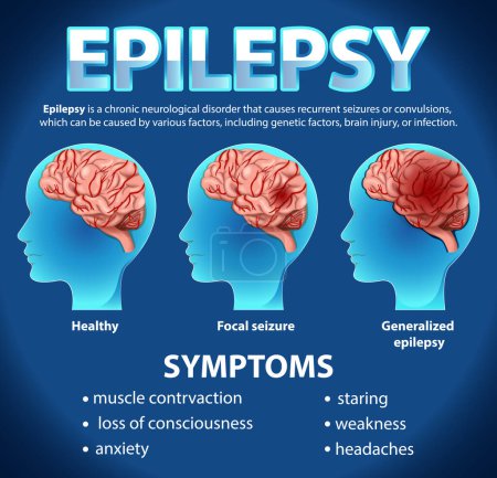 Téléchargez les illustrations : Affiche informative de l'illustration Epilepsie - en licence libre de droit