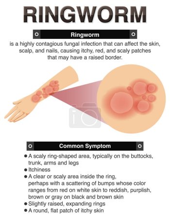Illustration for Informative symptoms of Ringworm illustration - Royalty Free Image