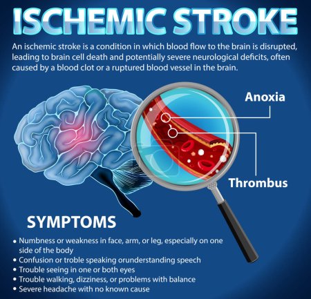 Illustration for Informative poster of Ischemic stroke illustration - Royalty Free Image