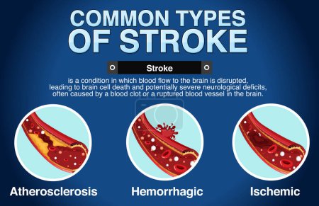 Illustration for Informative poster of common types of stoke illustration - Royalty Free Image