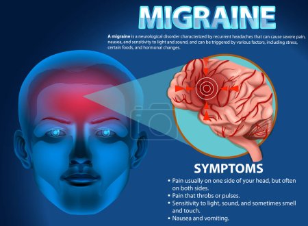 Illustration for Informative poster of Migraine illustration - Royalty Free Image