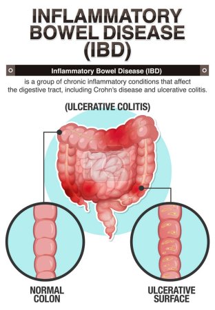 Illustration for Inflammatory Bowel Disease (IBD) Infographic illustration - Royalty Free Image