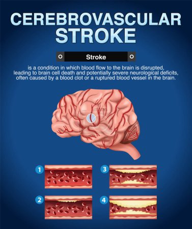 Illustration for Informative poster of Cerebrovascular stroke illustration - Royalty Free Image