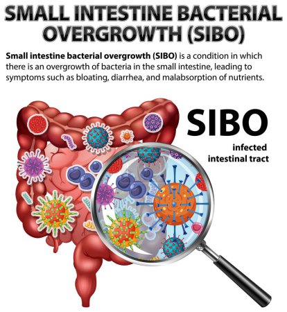 Dünndarmbakterielles Überwuchern (SIBO) Illustration