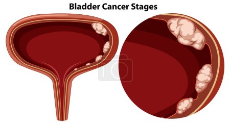 Bladder Cancer Stages Vector illustration