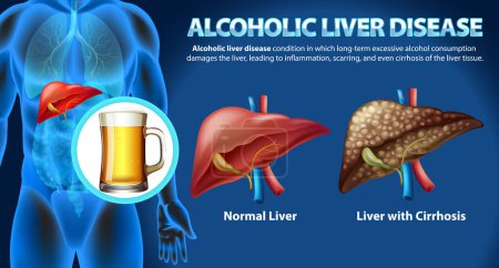 Illustration for Informative poster of alcoholic liver disease Cirrhosis illustration - Royalty Free Image
