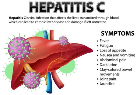 Ilustración de Explicación de la hepatitis C con ilustración de gráficos vectoriales - Imagen libre de derechos
