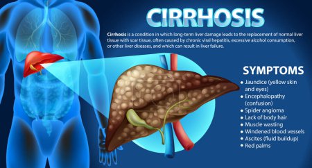 Ilustración de Cartel informativo de la enfermedad hepática alcohólica Cirrosis ilustración - Imagen libre de derechos