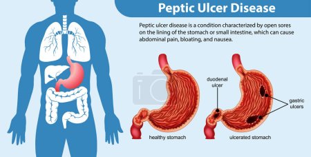 Illustration for Peptic Ulcer Disease Infographic illustration - Royalty Free Image