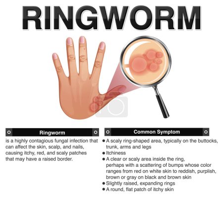 Illustration for Informative symptoms of Ringworm illustration - Royalty Free Image