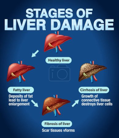 Ilustración de Etapas de daño hepático Ilustración infográfica - Imagen libre de derechos