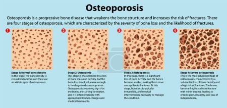 Ilustración de Densidad ósea y osteoporosis Vector ilustración - Imagen libre de derechos