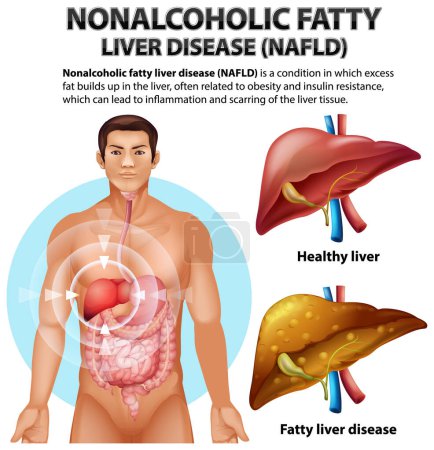 Ilustración de Enfermedad hepática grasa no alcohólica ilustración - Imagen libre de derechos