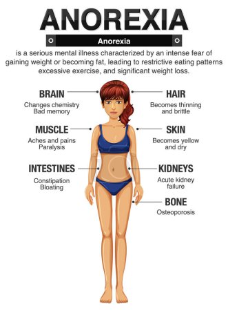 Ilustración de Anorexia (anorexia) y sus efectos en el cuerpo ilustración - Imagen libre de derechos