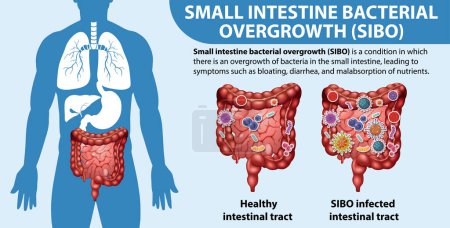 Illustration for Small Intestine Bacterial Overgrowth (SIBO) illustration - Royalty Free Image