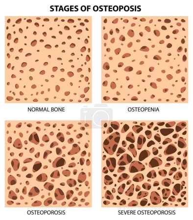 Etapas de la osteoposis Ilustración vectorial