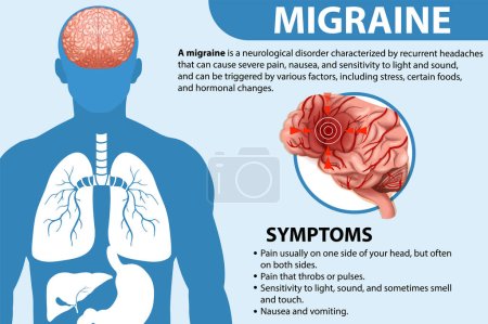 Téléchargez les illustrations : Affiche informative de l'illustration Migraine - en licence libre de droit