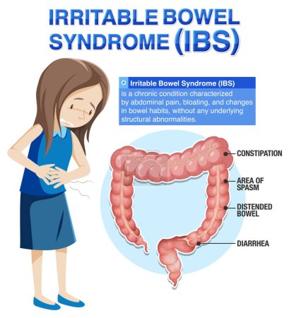 Síndrome del intestino irritable (SII) Ilustración infográfica