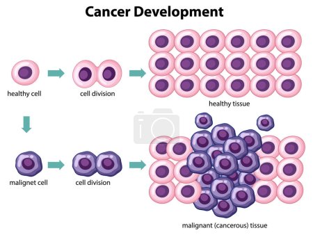 Vector de desarrollo del cáncer con ilustración de información