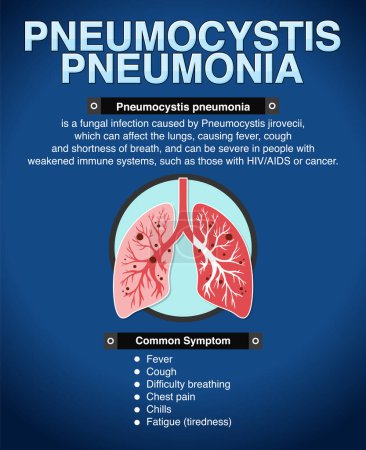 Illustration for Informative poster of Pneumocystis Pneumonia illustration - Royalty Free Image