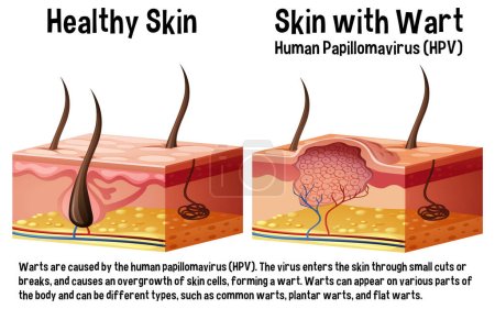 Ilustración de Piel sana y piel con infografía de verrugas con ilustración explicativa - Imagen libre de derechos