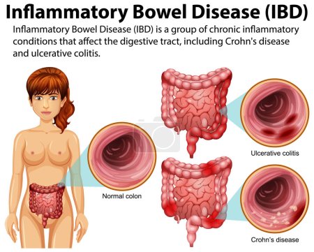 Téléchargez les illustrations : Maladie inflammatoire de l'intestin (MII) Illustration infographique - en licence libre de droit