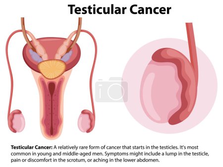 Ilustración de Ilustración de la anatomía masculina con cáncer testicular - Imagen libre de derechos