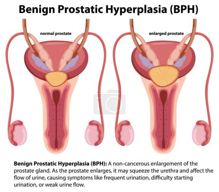 Ilustración de Infografía de dibujos animados que ilustra la hiperplasia prostática benigna masculina - Imagen libre de derechos