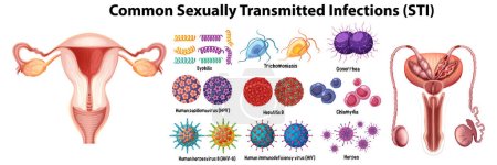 Ilustración de Infografía ilustrada que destaca infecciones de transmisión sexual comunes en hombres y mujeres - Imagen libre de derechos