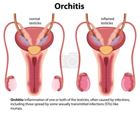 Dibujos animados vectoriales ilustración de la orquitis masculina enfermedad testicular