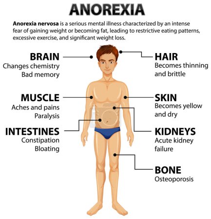 Ilustración de Ilustración que representa el impacto de la anorexia en varias funciones del cuerpo - Imagen libre de derechos